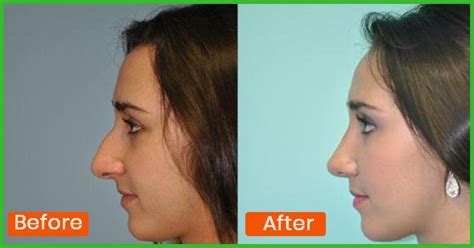 nose shaper results|Exercise for the Nose: Can It Reshape Y.